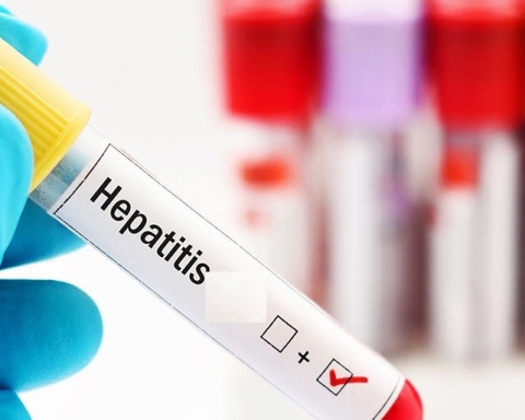 hepatitis akut
