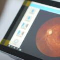 Deteksi Retinopati Diabetik dengan AI
